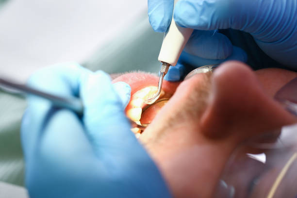 Best Emergency Wisdom Teeth Removal in Sammamish, WA